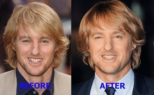 A picture of There is some change in Owen Wilson's nose before and after plastic surgery